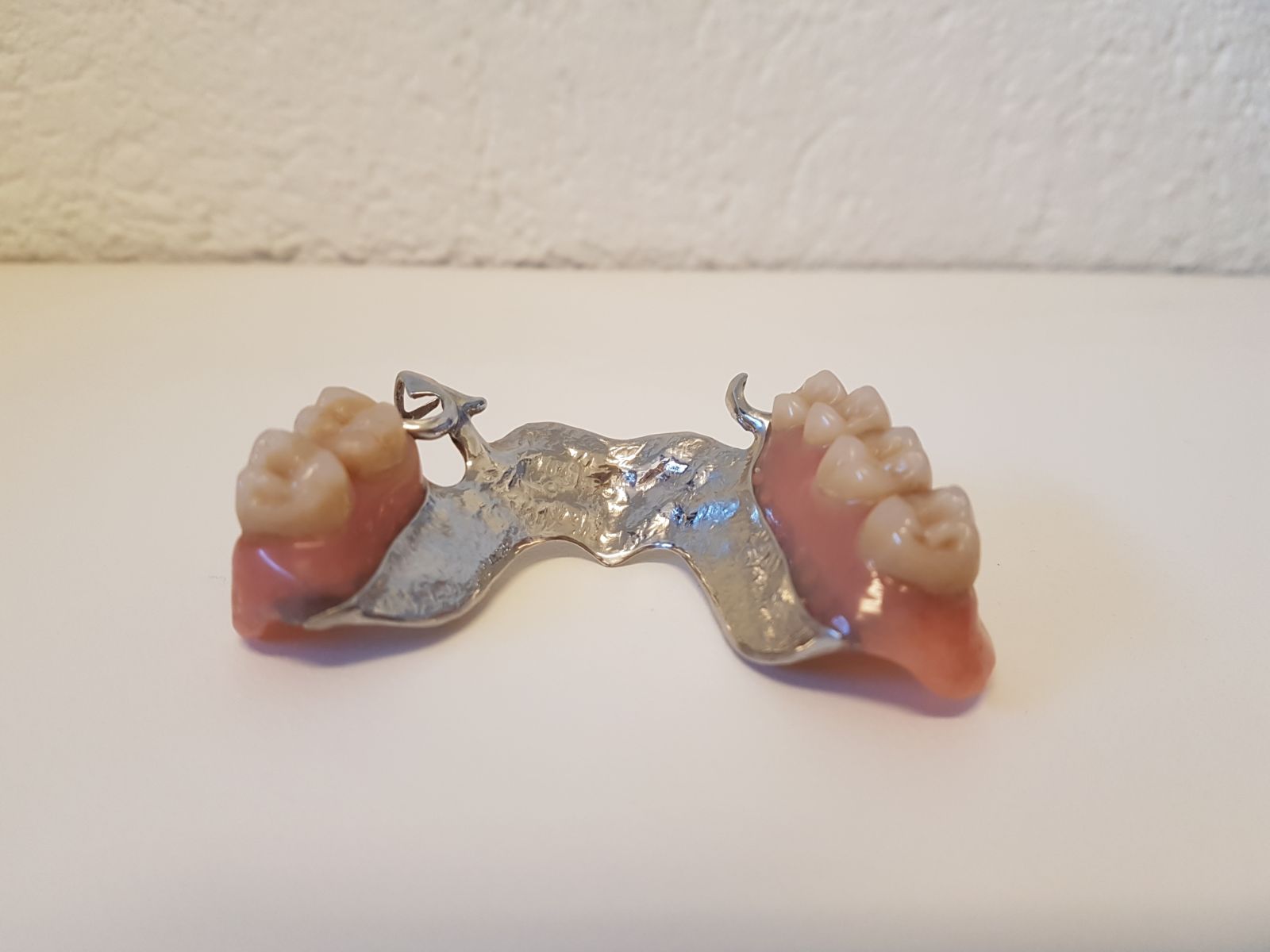 Prothèse partielle métallique